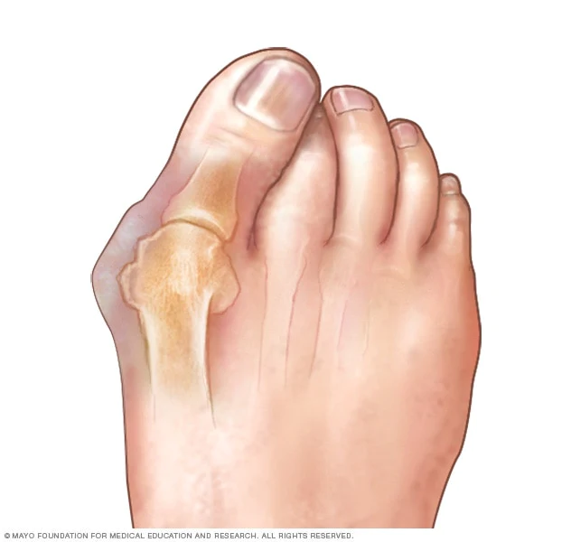 Hallux valgus Tavo kojinės